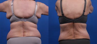 Semaglutide Weight Loss Before & After Gallery - Patient 495103 - Image 1