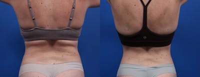 Semaglutide Weight Loss Before & After Gallery - Patient 214113 - Image 2