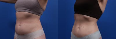 Semaglutide Weight Loss Before & After Gallery - Patient 214113 - Image 1