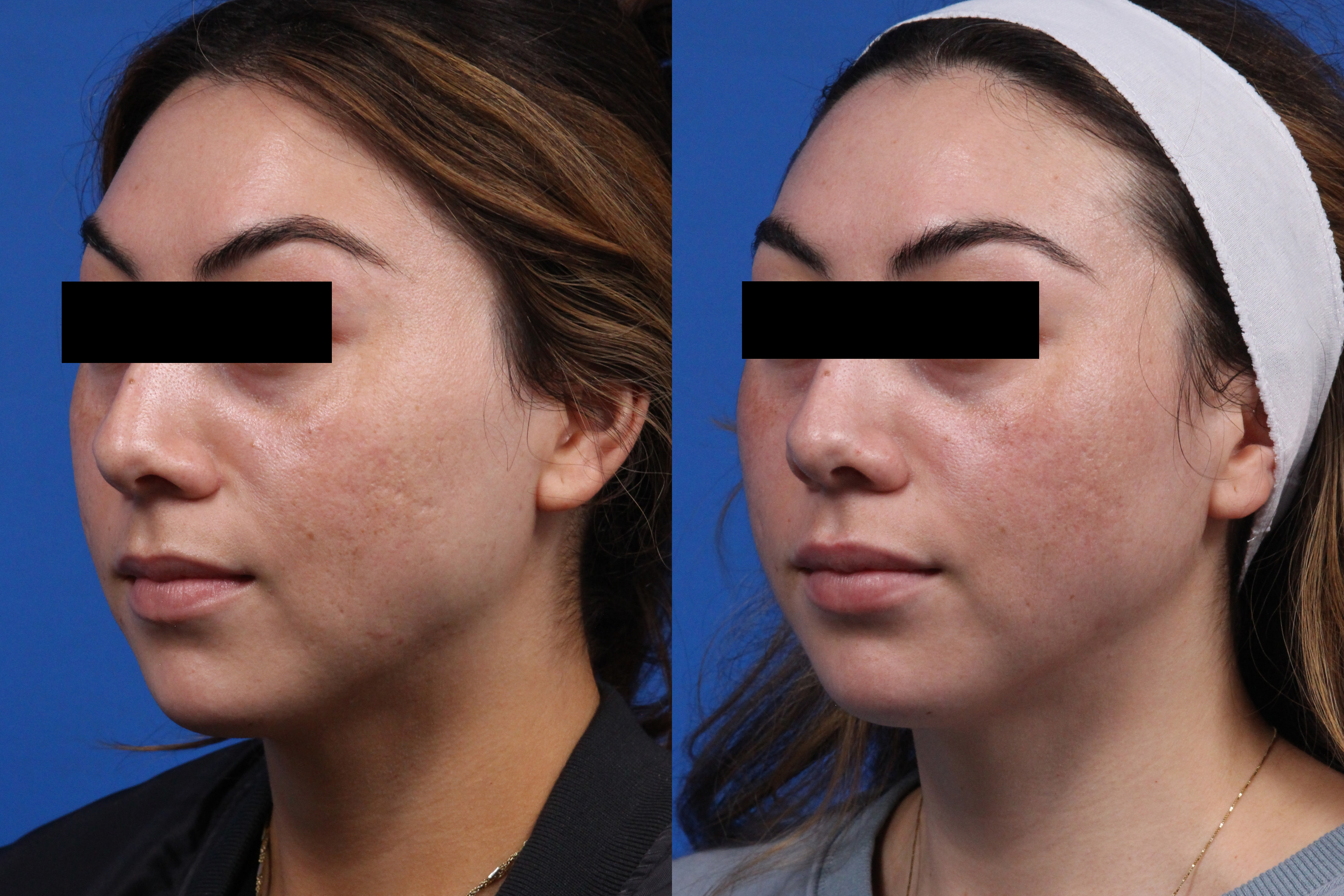 Acne Treatment Gallery Before & After Gallery - Patient 219877 - Image 3
