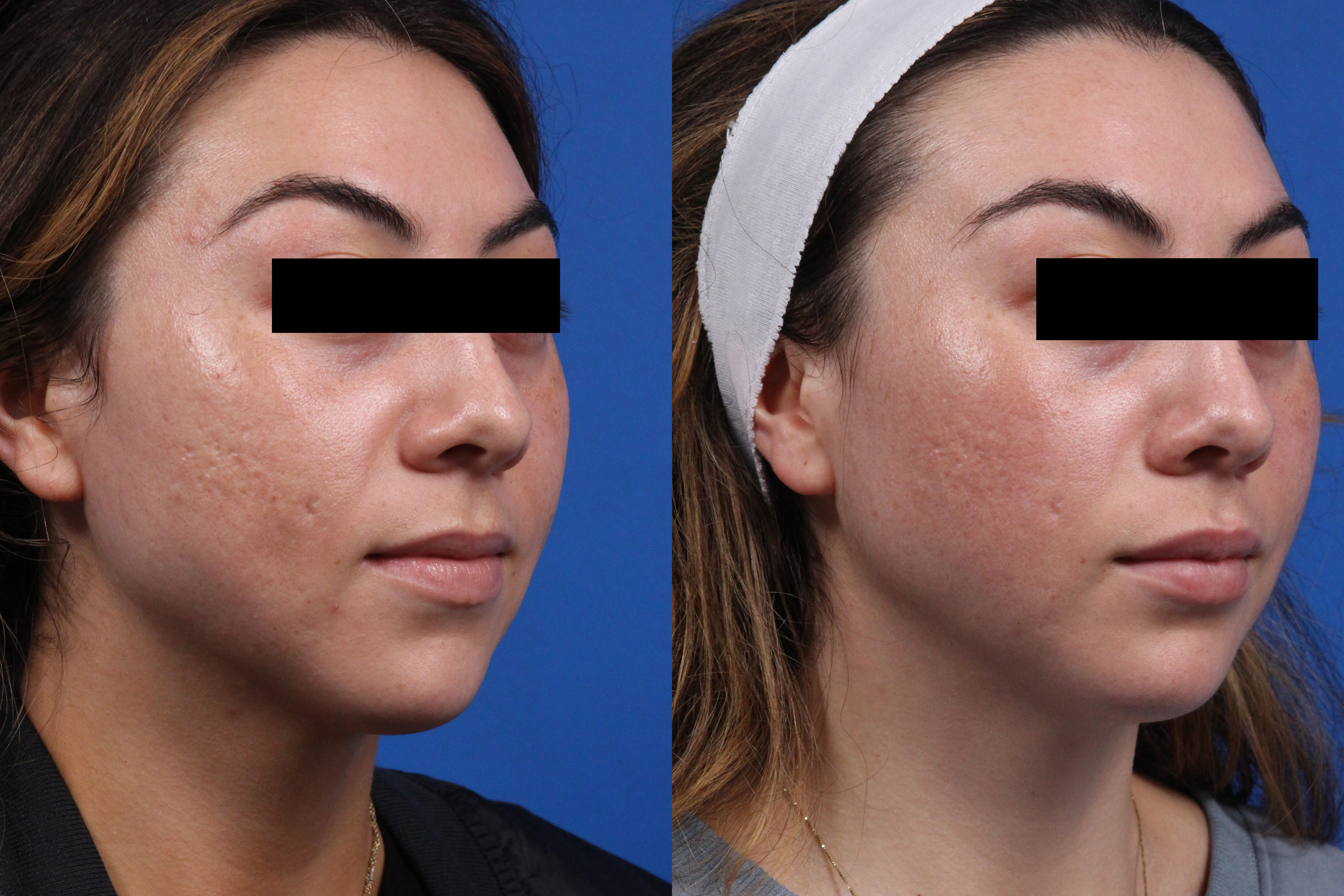 Acne Treatment Gallery Before & After Gallery - Patient 219877 - Image 2