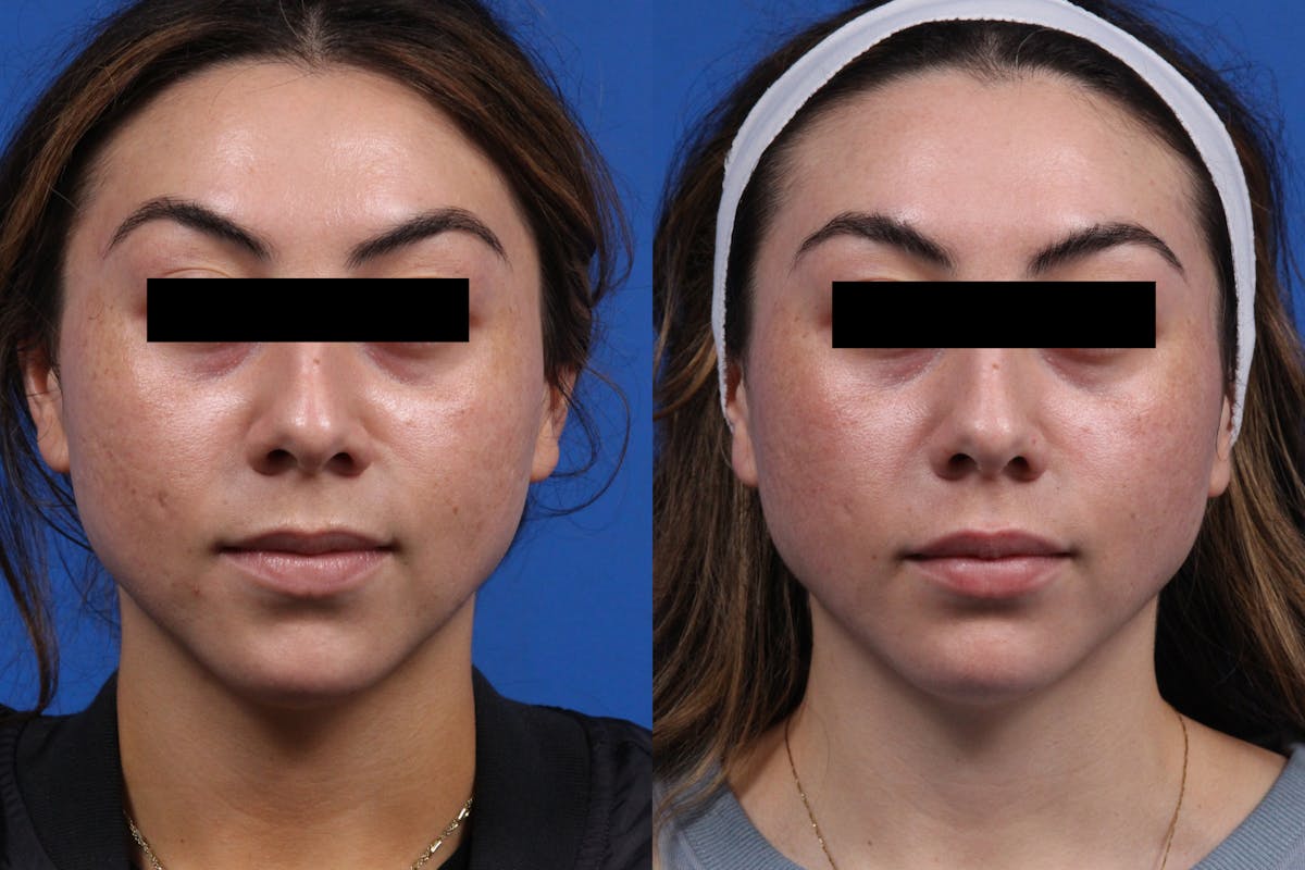 Acne Treatment Gallery Before & After Gallery - Patient 219877 - Image 1