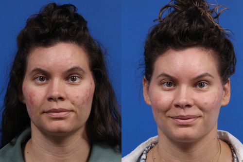IPL Photorejuvenation Gallery Before & After Gallery - Patient 384656 - Image 1
