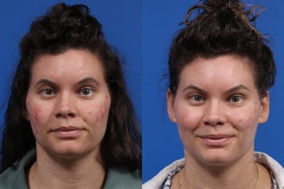IPL Photorejuvenation Gallery Before & After Gallery - Patient 384656 - Image 1