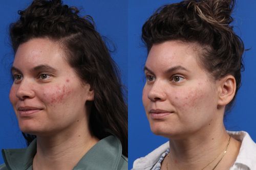 IPL Photorejuvenation Gallery Before & After Gallery - Patient 384656 - Image 2