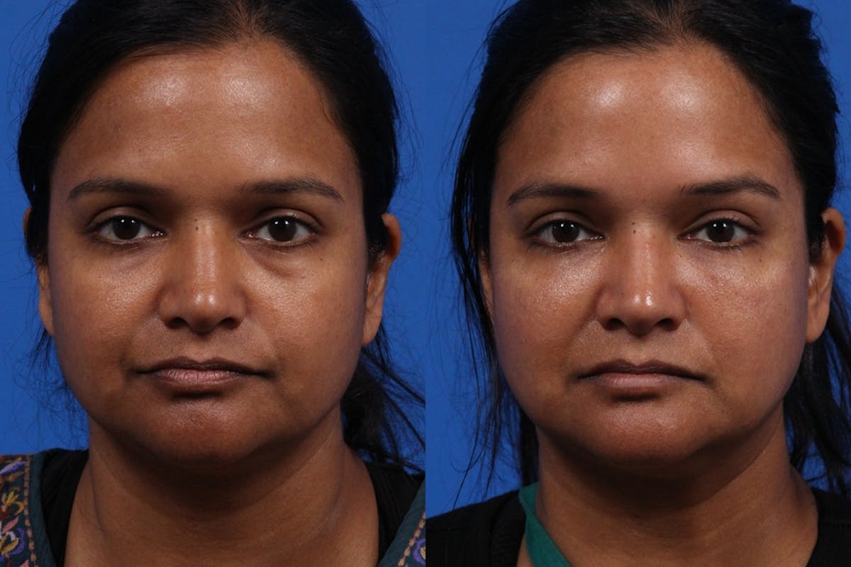 EZ Gel PRF Before & After Gallery - Patient 531474 - Image 1