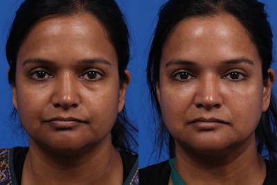 EZ Gel PRF Before & After Gallery - Patient 531474 - Image 1