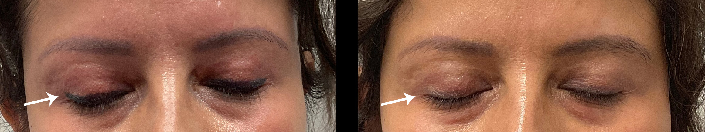 Laser Tattoo Removal Gallery Before & After Gallery - Patient 24560611 - Image 1