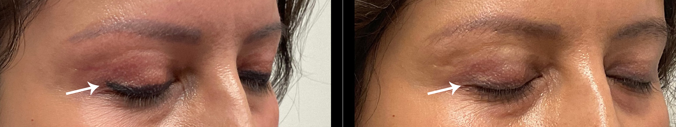 Laser Tattoo Removal Gallery Before & After Gallery - Patient 24560611 - Image 2