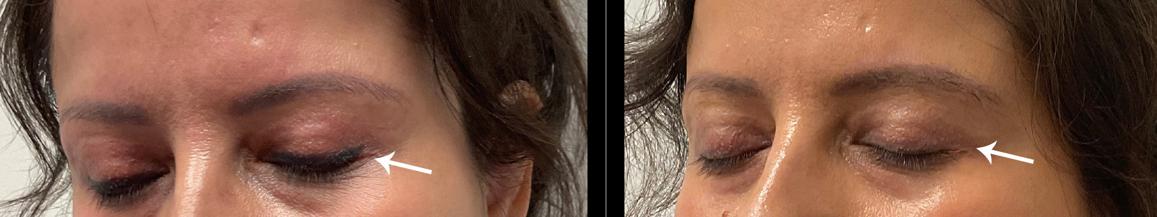 Laser Tattoo Removal Gallery Before & After Gallery - Patient 24560611 - Image 3