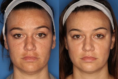 LaserFirm Gallery Before & After Gallery - Patient 143416456 - Image 1