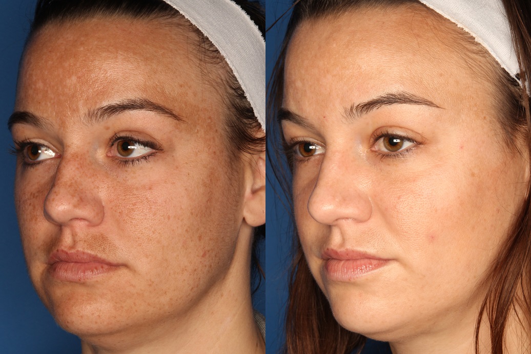 LaserFirm Gallery Before & After Gallery - Patient 143416456 - Image 4