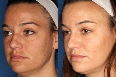 LaserFirm Gallery Before & After Gallery - Patient 143416456 - Image 4