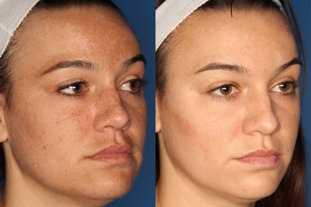 LaserFirm Gallery Before & After Gallery - Patient 143416456 - Image 2