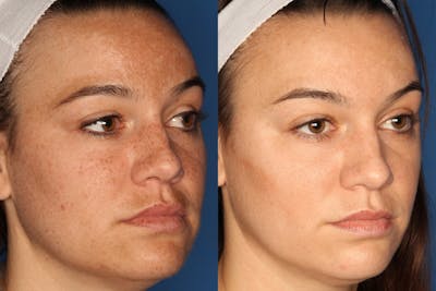 LaserFirm Gallery Before & After Gallery - Patient 143416456 - Image 2