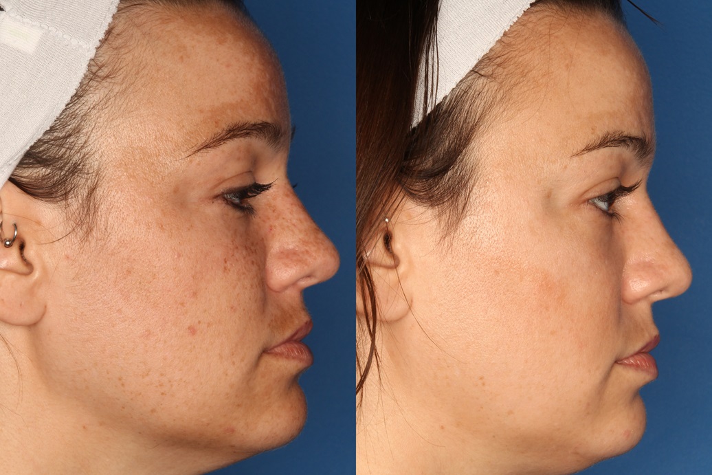 LaserFirm Gallery Before & After Gallery - Patient 143416456 - Image 3
