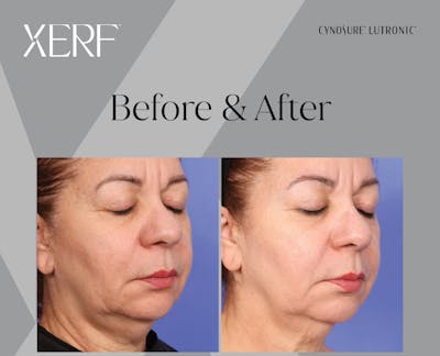 XERF Gallery Before & After Gallery - Patient 144685 - Image 2