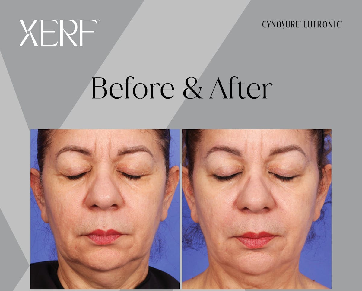 XERF Gallery Before & After Gallery - Patient 144685 - Image 1