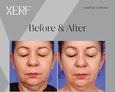 XERF Gallery Before & After Gallery - Patient 144685 - Image 1