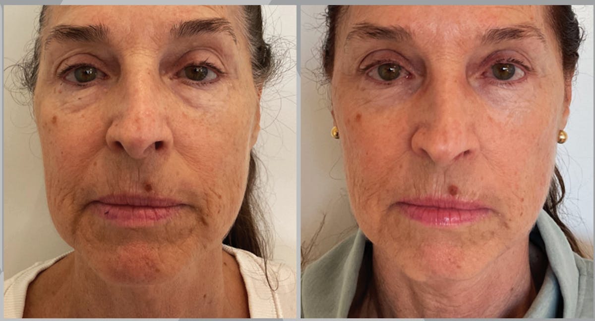 XERF Gallery Before & After Gallery - Patient 413822 - Image 1