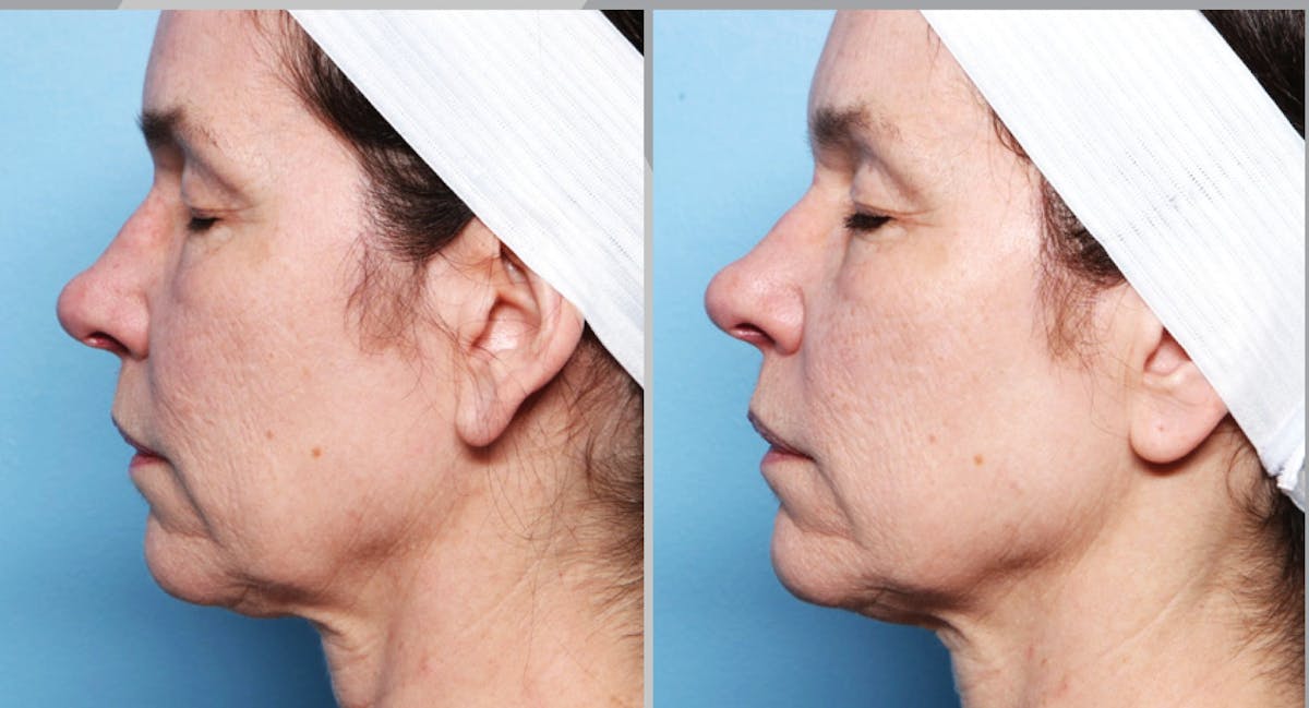 XERF Gallery Before & After Gallery - Patient 209721 - Image 1