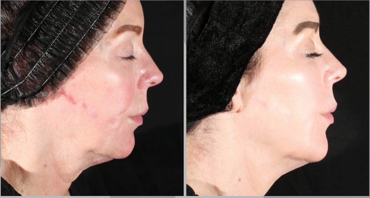 XERF Gallery Before & After Gallery - Patient 244383 - Image 1