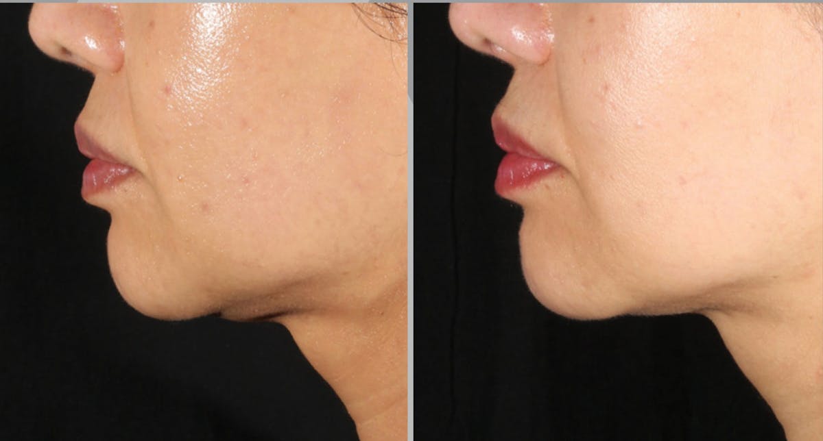 XERF Gallery Before & After Gallery - Patient 115522 - Image 1