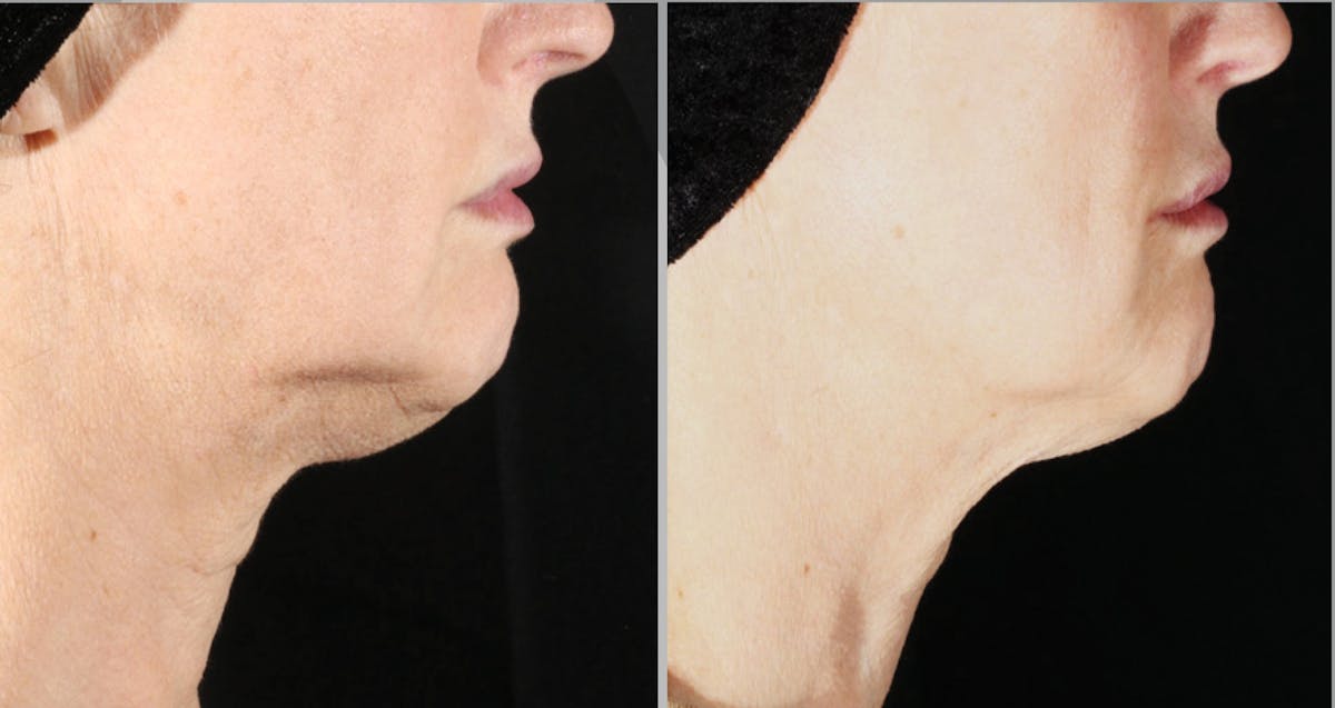 XERF Gallery Before & After Gallery - Patient 315760 - Image 1