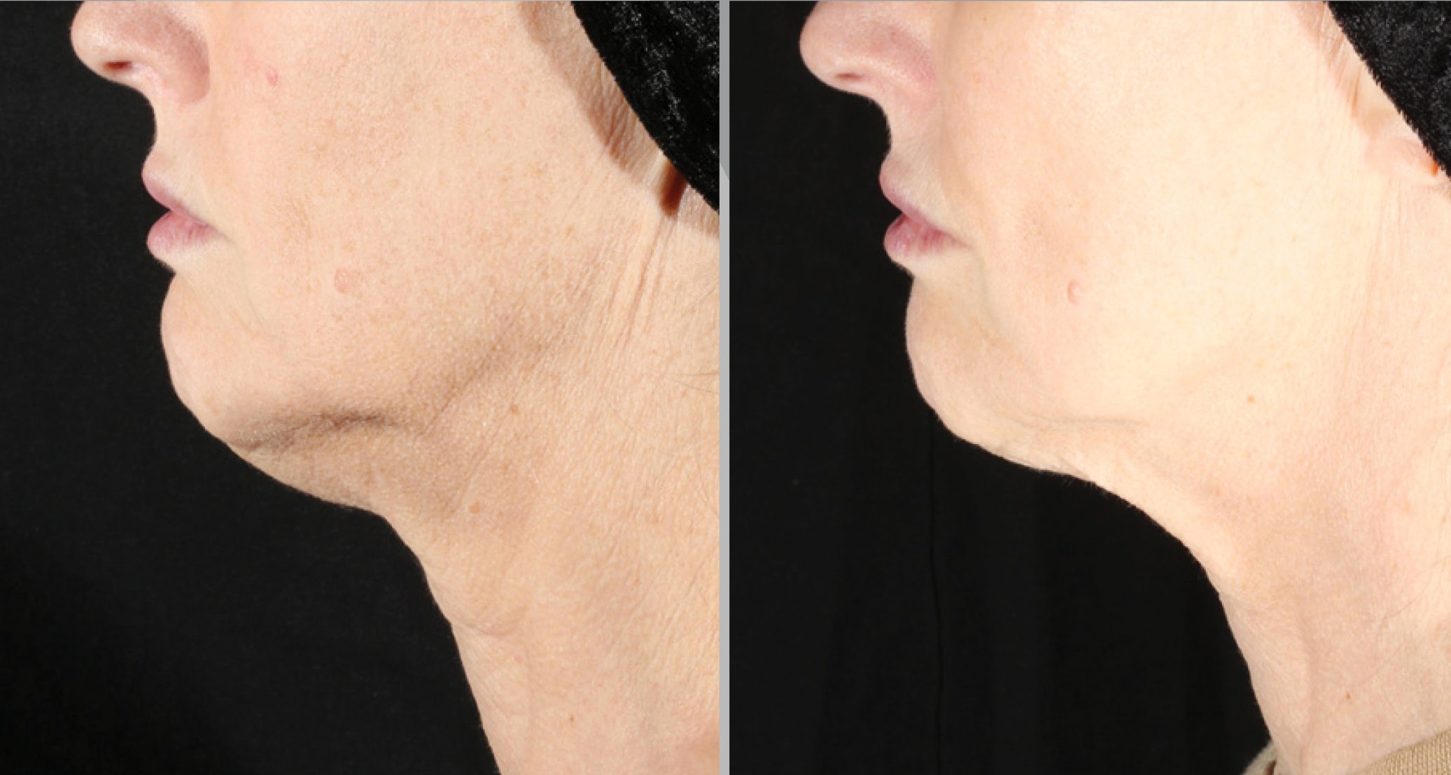 XERF Gallery Before & After Gallery - Patient 315760 - Image 2