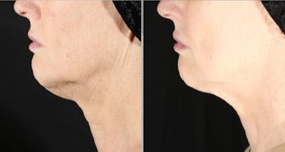 XERF Gallery Before & After Gallery - Patient 315760 - Image 2