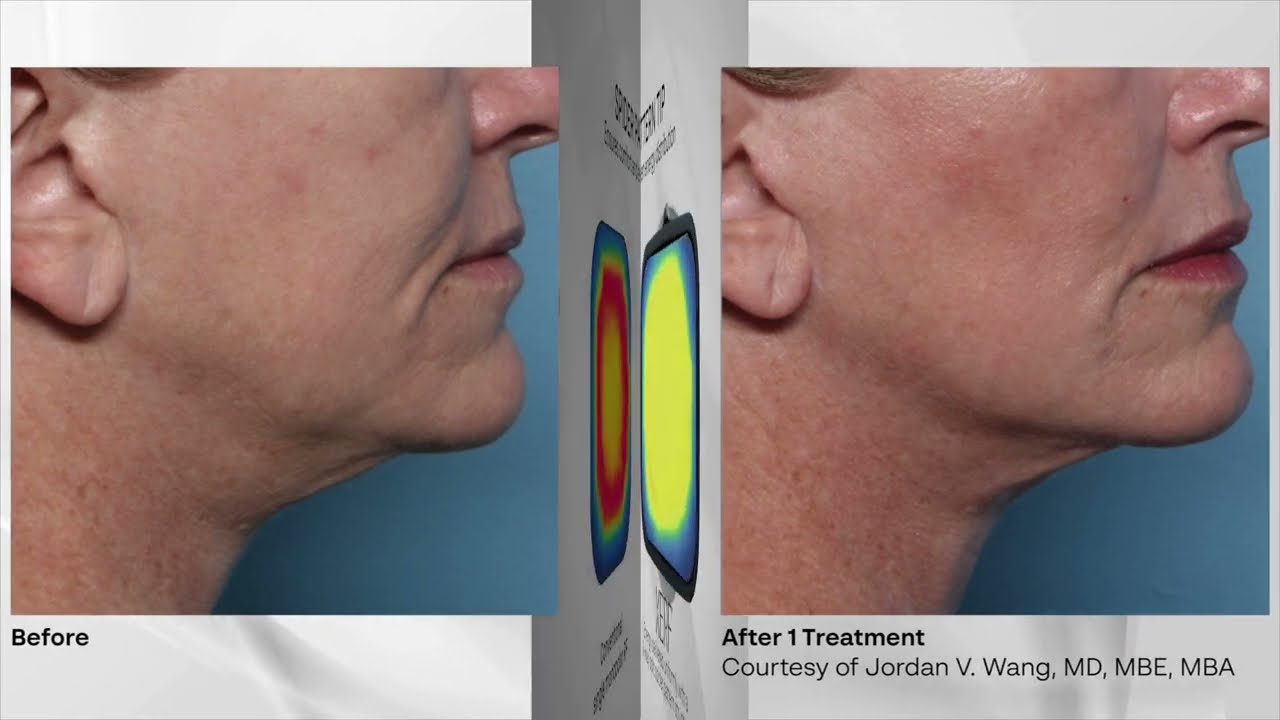 XERF Skin Tightening in San Diego | Laser Clinique