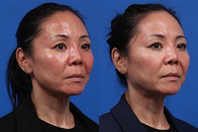 Excel V. Gallery Before & After Gallery - Patient 779350 - Image 2