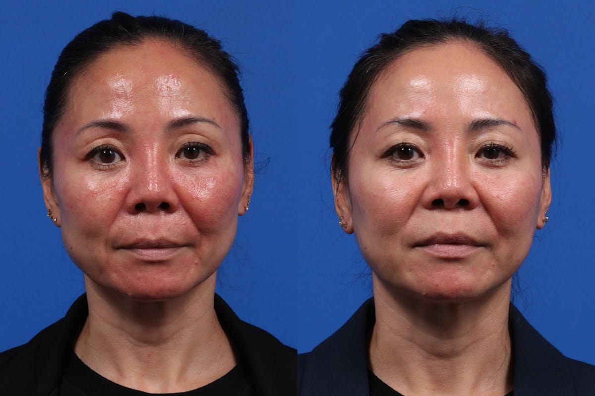 Excel V. Gallery Before & After Gallery - Patient 779350 - Image 1