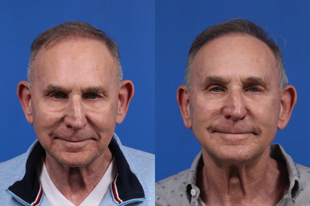 XERF Gallery Before & After Gallery - Patient 216508 - Image 5