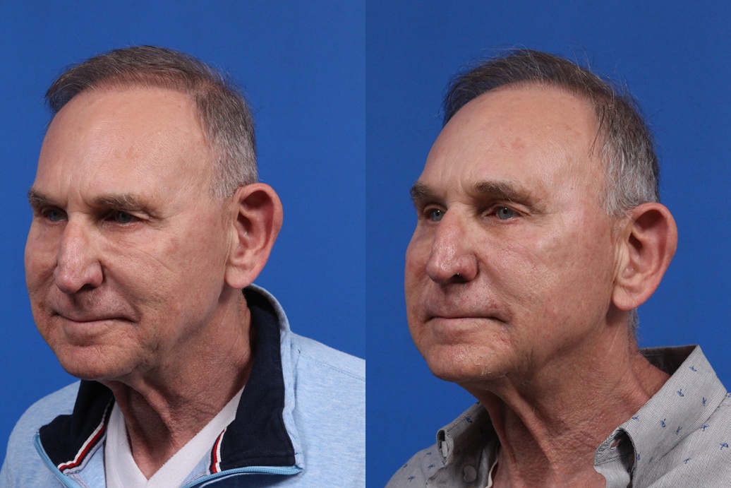 XERF Gallery Before & After Gallery - Patient 216508 - Image 3