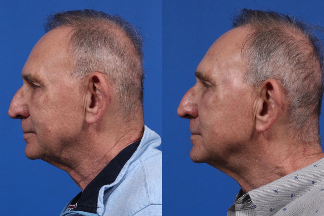 XERF Gallery Before & After Gallery - Patient 216508 - Image 4