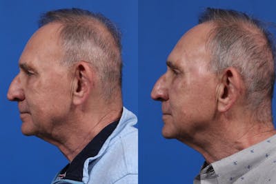 XERF Gallery Before & After Gallery - Patient 216508 - Image 4