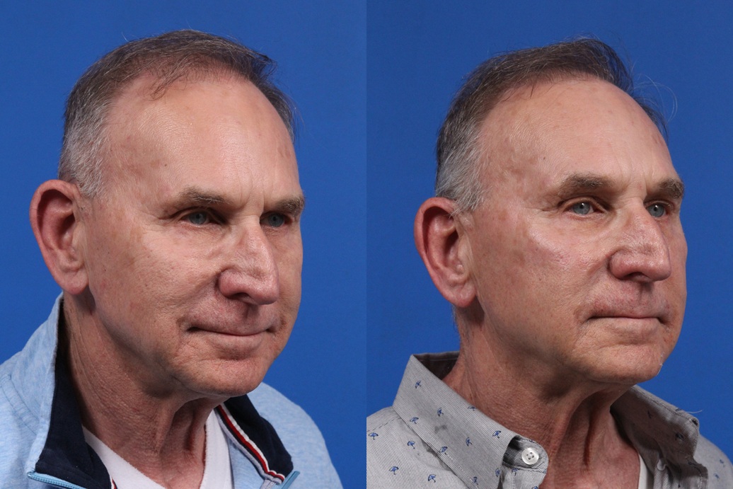 XERF Gallery Before & After Gallery - Patient 216508 - Image 2