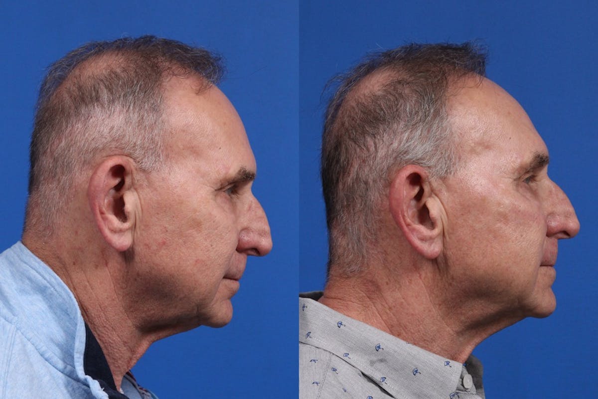 XERF Gallery Before & After Gallery - Patient 216508 - Image 1