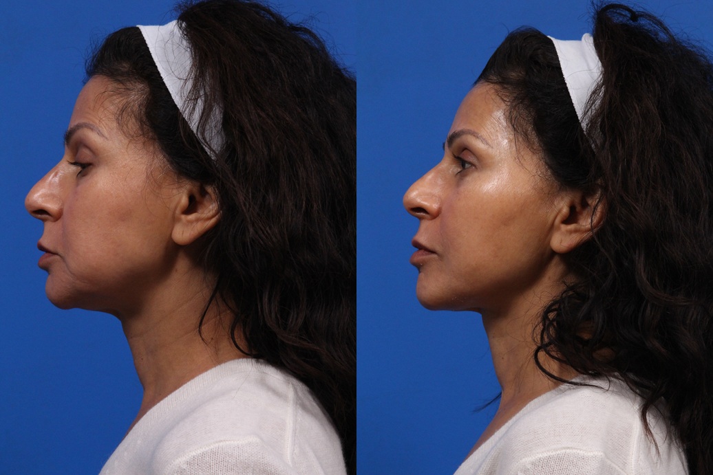 XERF Gallery Before & After Gallery - Patient 199593 - Image 2