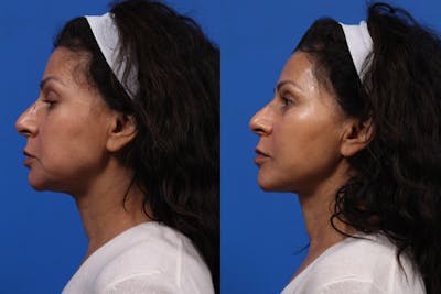 XERF Gallery Before & After Gallery - Patient 199593 - Image 2