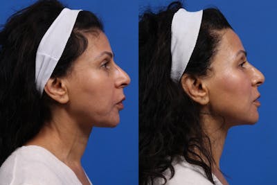 XERF Gallery Before & After Gallery - Patient 199593 - Image 1