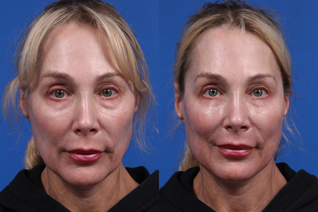Dermal Fillers Gallery Before & After Gallery - Patient 401772 - Image 3