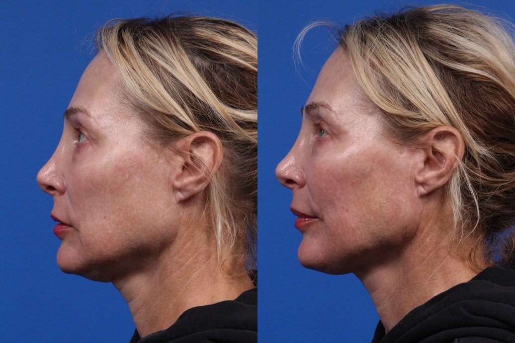 Dermal Fillers Gallery Before & After Gallery - Patient 401772 - Image 2