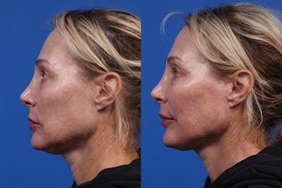 Dermal Fillers Gallery Before & After Gallery - Patient 401772 - Image 2