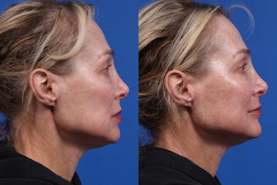 Dermal Fillers Gallery Before & After Gallery - Patient 401772 - Image 1