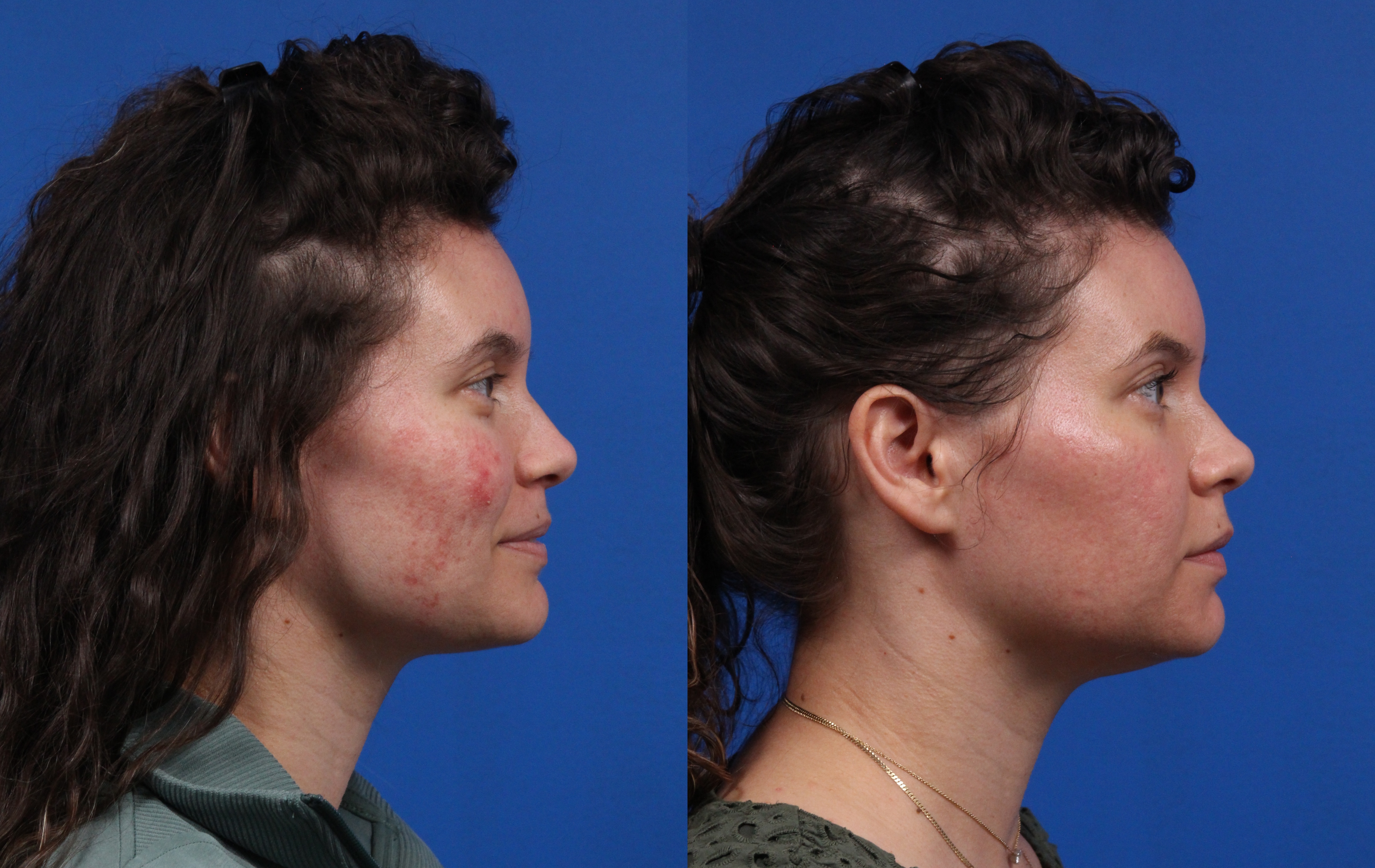HALO® Laser by Sciton Gallery Before & After Gallery - Patient 408423 - Image 3