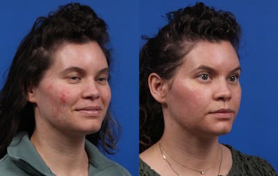 HALO® Laser by Sciton Gallery Before & After Gallery - Patient 408423 - Image 2