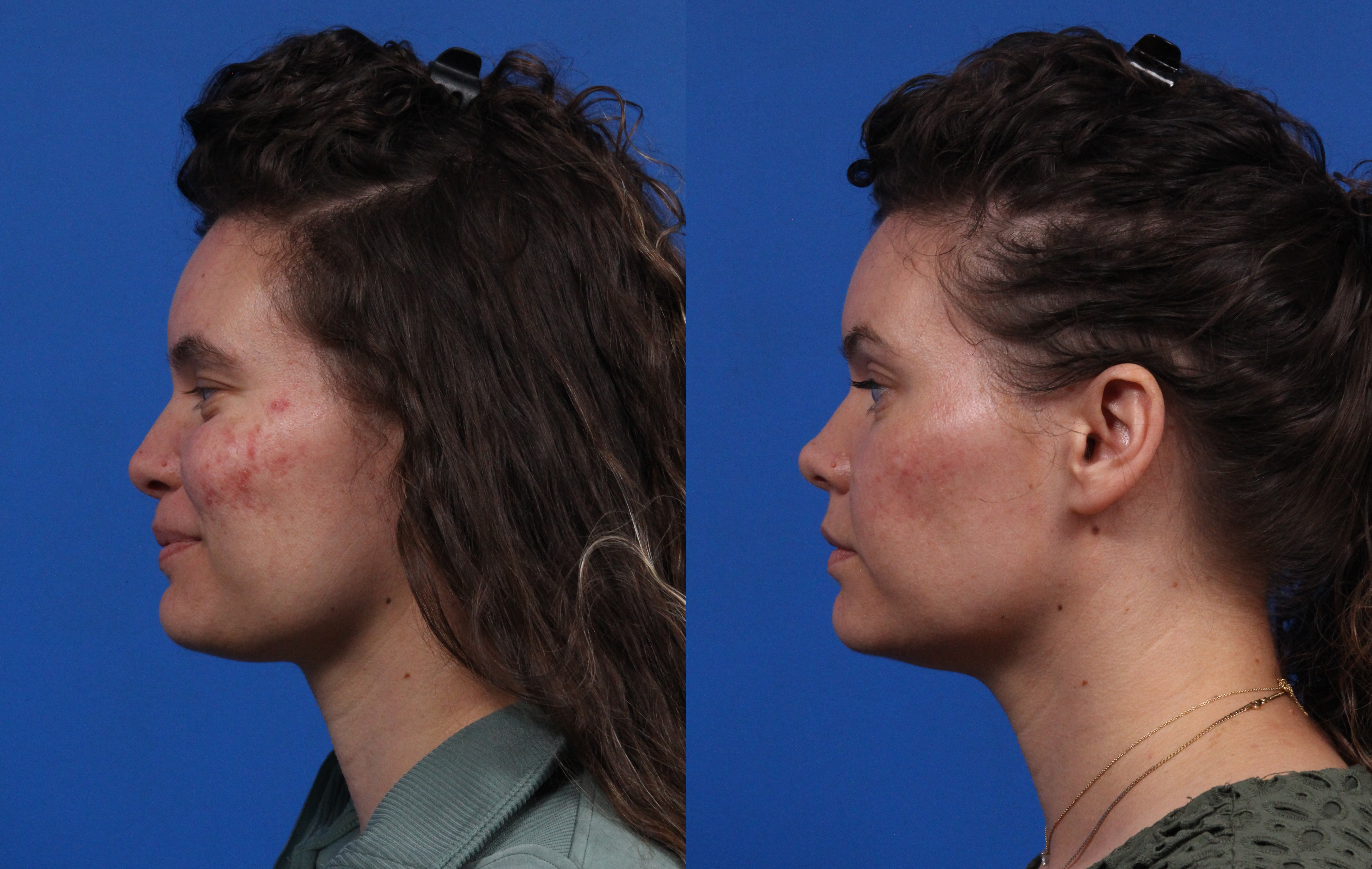 HALO® Laser by Sciton Gallery Before & After Gallery - Patient 408423 - Image 5