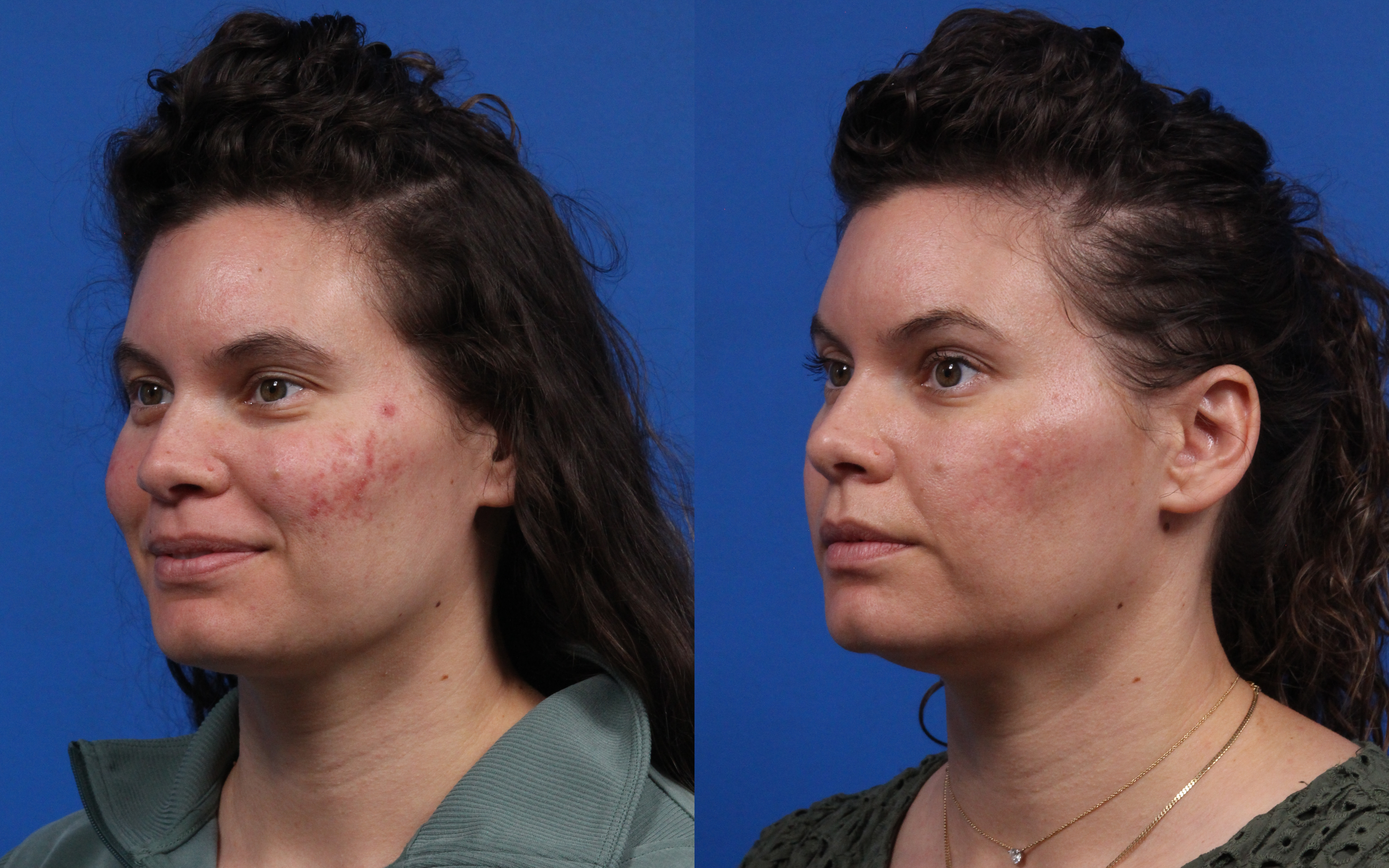 HALO® Laser by Sciton Gallery Before & After Gallery - Patient 408423 - Image 4